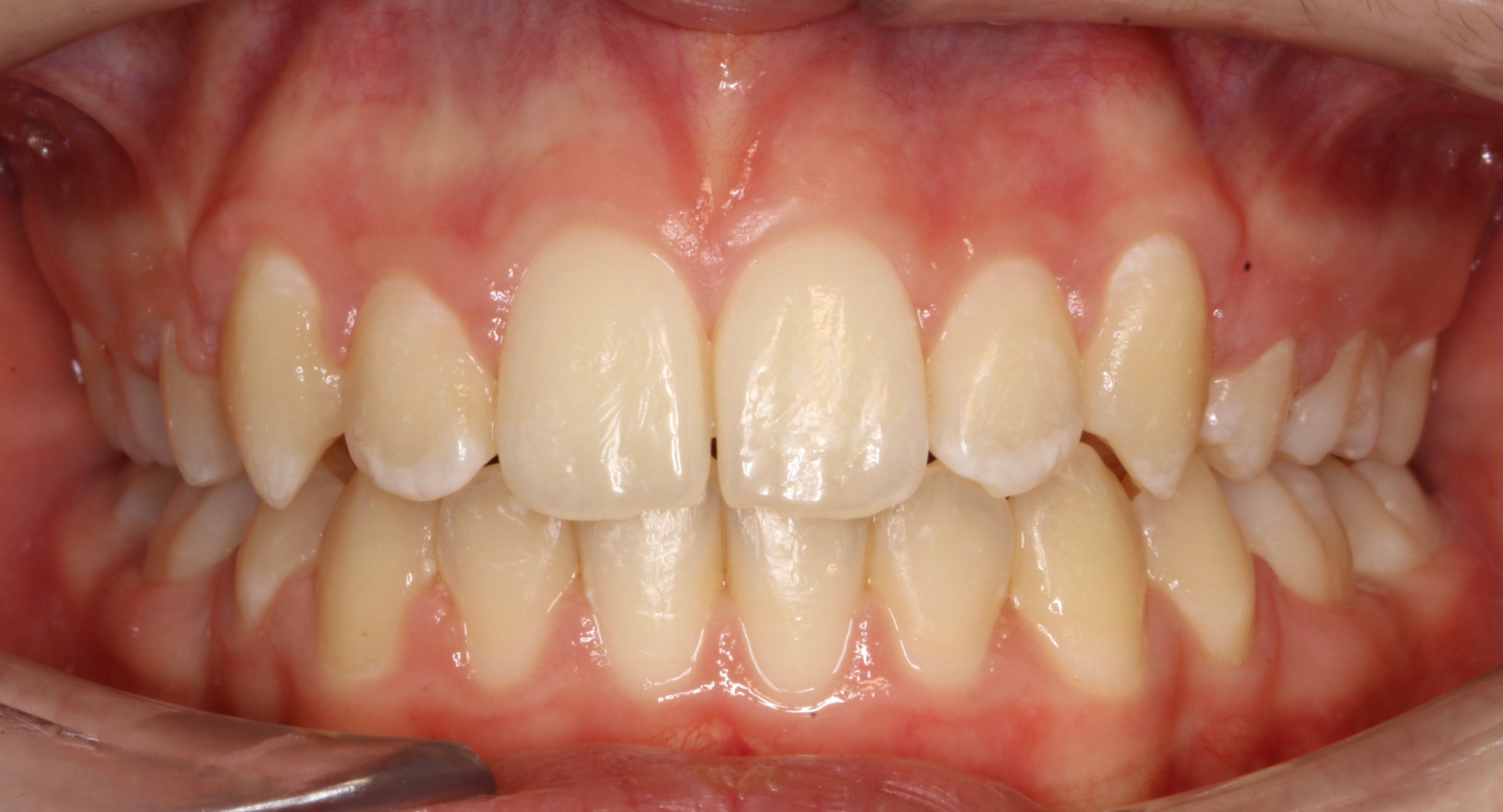 Fixed Braces Nottingham The Campbell Clinic